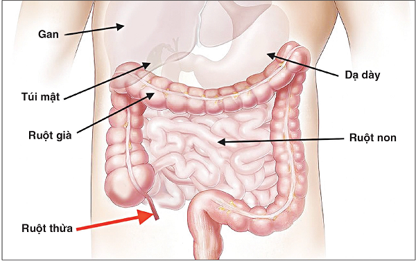 Tắc nghẽn lòng ruột thừa